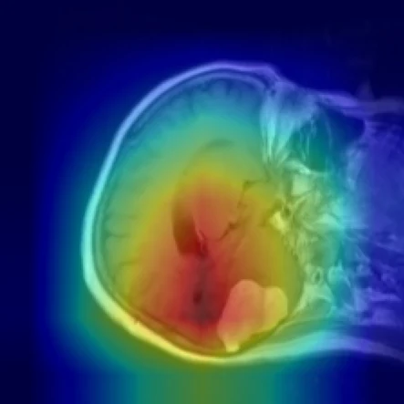 Brain Tumor MRI Classification